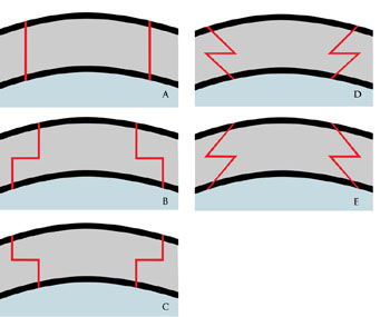 ophthalmic cases, keratoplasty, laser assisted keratoplasty, femtosecond laser, Fuchs endothelial dystrophy, top hat